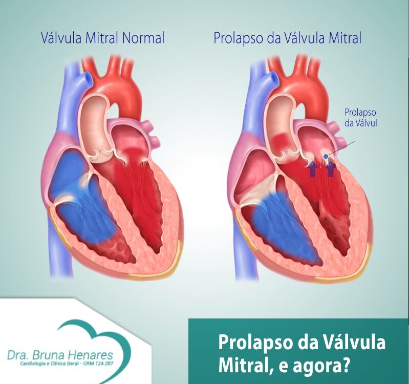 Prolapso da válvula mitral