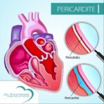 Periocardite