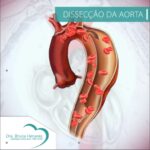 dissecção da aorta