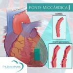 ponte miocárdica é cardiopatia grave, ponte miocardica, ponte miocárdica é hereditário, ponte do miocardio, agende sua consulta com a Dra. Bruna Henares