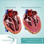 Miocardiopatia Hipertrófica