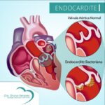 Endocardite