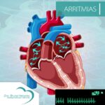 Arritmia - Taquicardia supraventricular