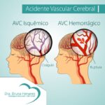 Acidente vascular cerebral