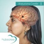 Aneurisma Cerebral