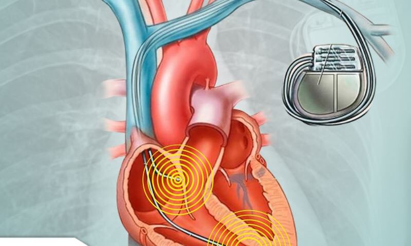 Cardiodesfibrilador Implantável