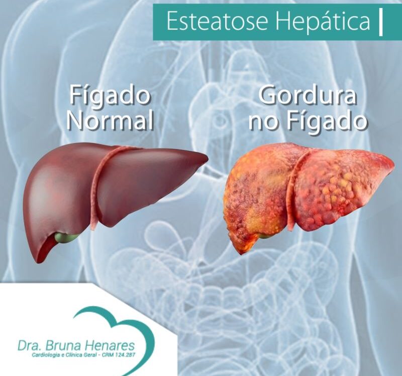 Esteatose Hepática